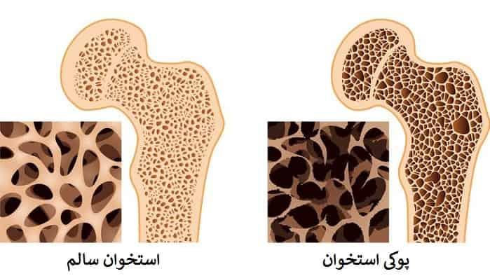 بیماری شایع ای به نام پوکی استخوان