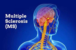 استان مرکزی، پیشرو در درمان و تشخیص بیماران ام اس